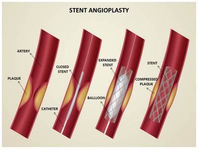 Coronary Stent Editable PowerPoint Template