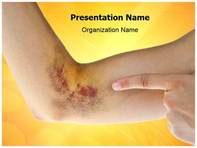 Hematoma Editable PowerPoint Template