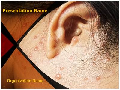 Chicken Pox Behind Ears Editable PowerPoint Template