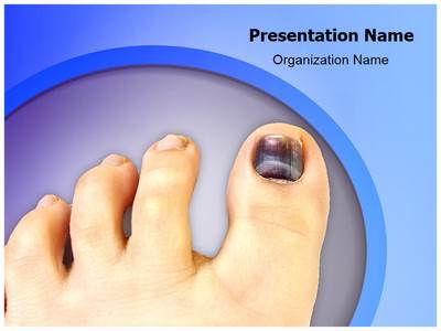 Nail Hematoma Editable PowerPoint Template