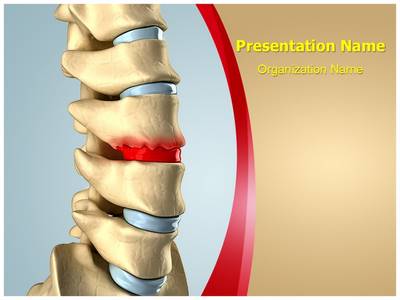 Disc Osteophyte Formation Editable PowerPoint Template