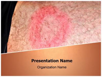 Lyme Disease Editable PowerPoint Template