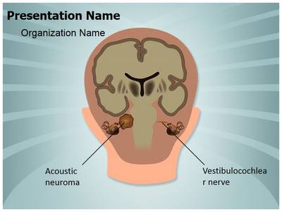 Acoustic Neuroma Vestibulocochlear Nerve Editable PowerPoint Template