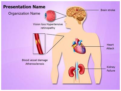 Complications of hypertension Editable PowerPoint Template