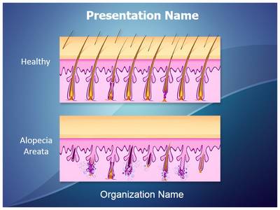 Baldness Alopecia Areata Editable PowerPoint Template