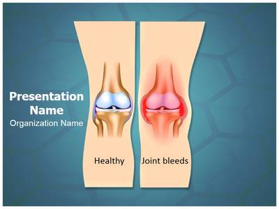Hemophilia Joint Bleeding Editable PowerPoint Template