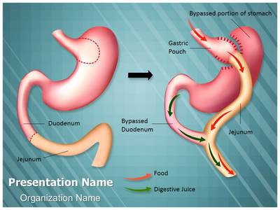 Weight Loss Roux En Y Editable PowerPoint Template