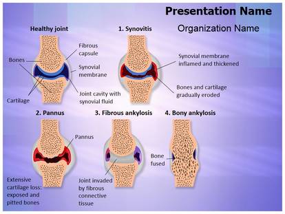 rheumatoid arthritis ppt