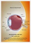 Retinal detachment Editable Template