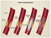 Coronary Stent Editable Template