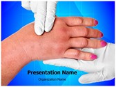 swollen hand Editable Template