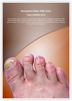 Toenail Mycosis