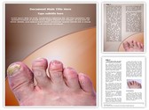 Toenail Mycosis Editable PowerPoint Template