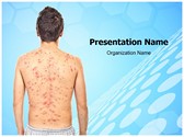 Chickenpox Rash Template