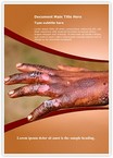 Burn Injuries Editable Template