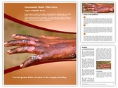 Burn Injuries Editable PowerPoint Template