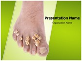 Foot Mycosis Editable Template