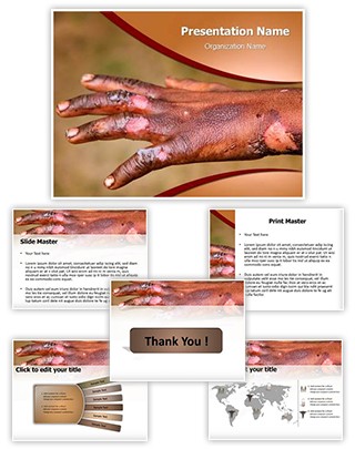 Burn Injuries Editable PowerPoint Template