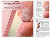 Psoriasis on Arms Editable PowerPoint Template