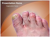 Toenail Mycosis Template