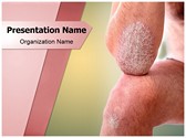 Psoriasis on Arms Editable PowerPoint Template