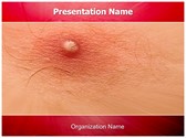 Skin Boils Editable PowerPoint Template