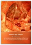 Diverticulosis