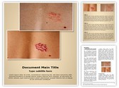 Herpes Zoster Editable PowerPoint Template