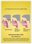 Snoring and Sleep Apnea Editable Template