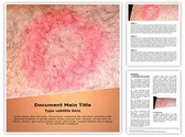 Lyme Disease Editable PowerPoint Template