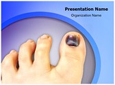 Nail Hematoma Editable PowerPoint Template