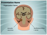 Acoustic Neuroma Vestibulocochlear Nerve Editable PowerPoint Template