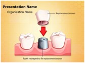 Dental Crown Procedure PowerPoint Templates