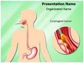 Esophageal Cancer Editable PowerPoint Template