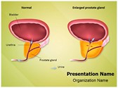 Benign Prostatic Hyperplasia Editable PowerPoint Template