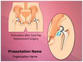 Hip Replacement Surgery Dislocation Editable PowerPoint Template