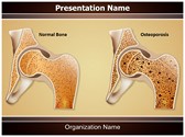 Osteopathy Osteoporosis Editable PowerPoint Template