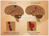 Ischemic Hemorrhagic Brain Stroke