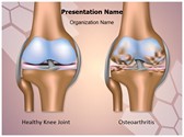 Knee Joint Osteoarthritis Editable PowerPoint Template