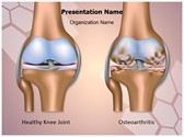 Knee Joint Osteoarthritis Template