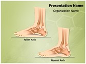 Pes Planus Flat Foot Editable PowerPoint Template