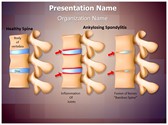 Spine Ankylosing Spondylitis Editable PowerPoint Template