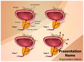 Prostate Cancer Stages Editable PowerPoint Template