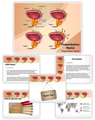 Prostate Cancer Stages Editable PowerPoint Template