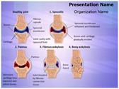 Synovial Rheumatoid Arthritis Stages Template