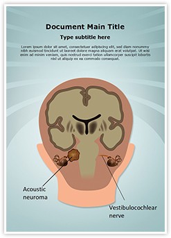 Acoustic Neuroma Vestibulocochlear Nerve