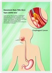 Esophageal Cancer Editable Template