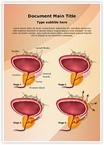 Prostate Cancer Stages Editable Template