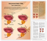 Prostate Cancer Stages Editable PowerPoint Template