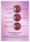 Optometrist Presbyopia Editable Template